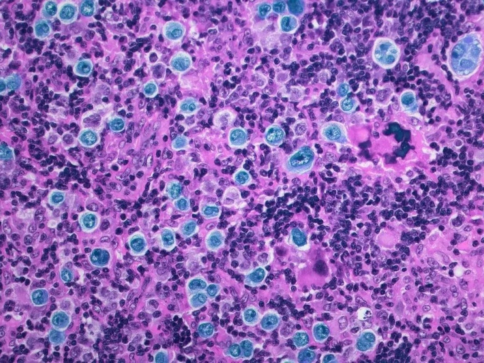 la innovadora terapia contra el cáncer que ya se empezó a usar en Argentina