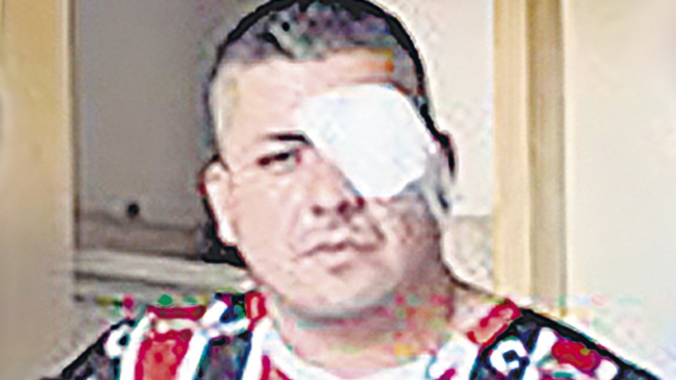 Perdió la visión de un ojo