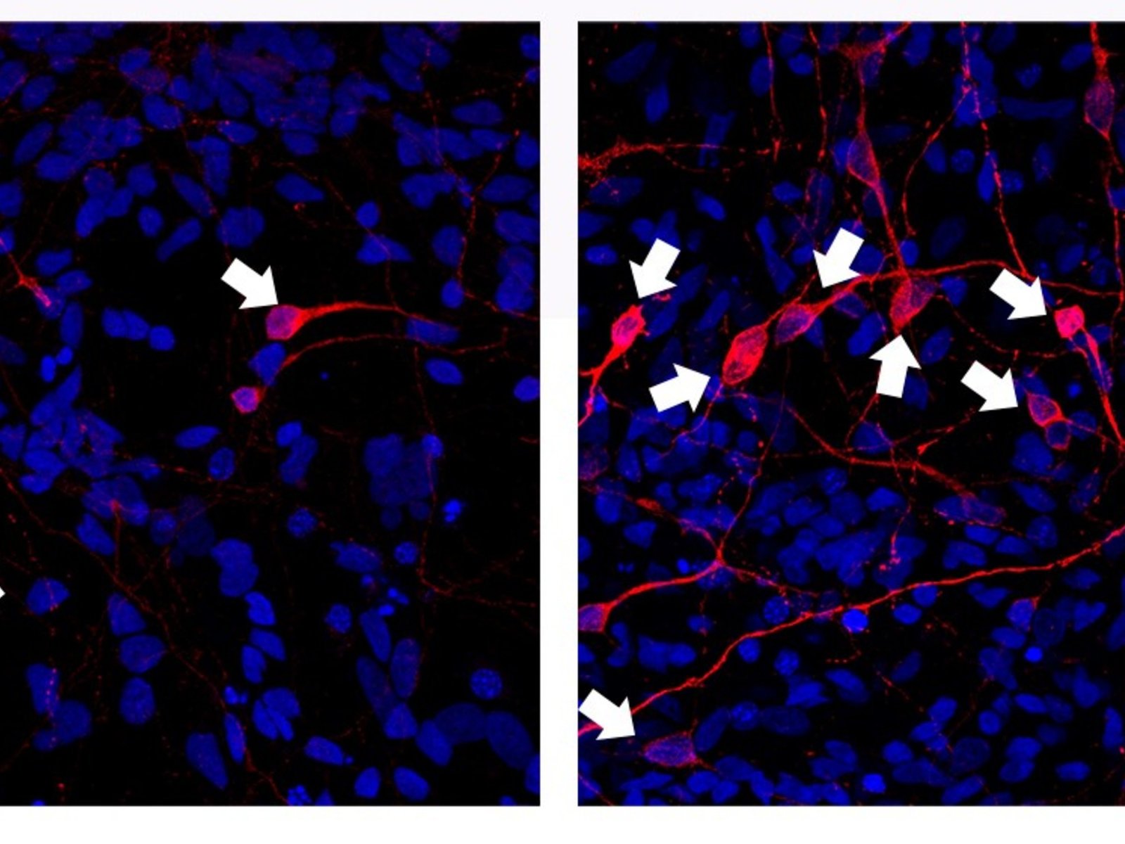 La ciencia trae dos buenas noticias para el tratamiento del Parkinson con células madre: seguridad y eficacia