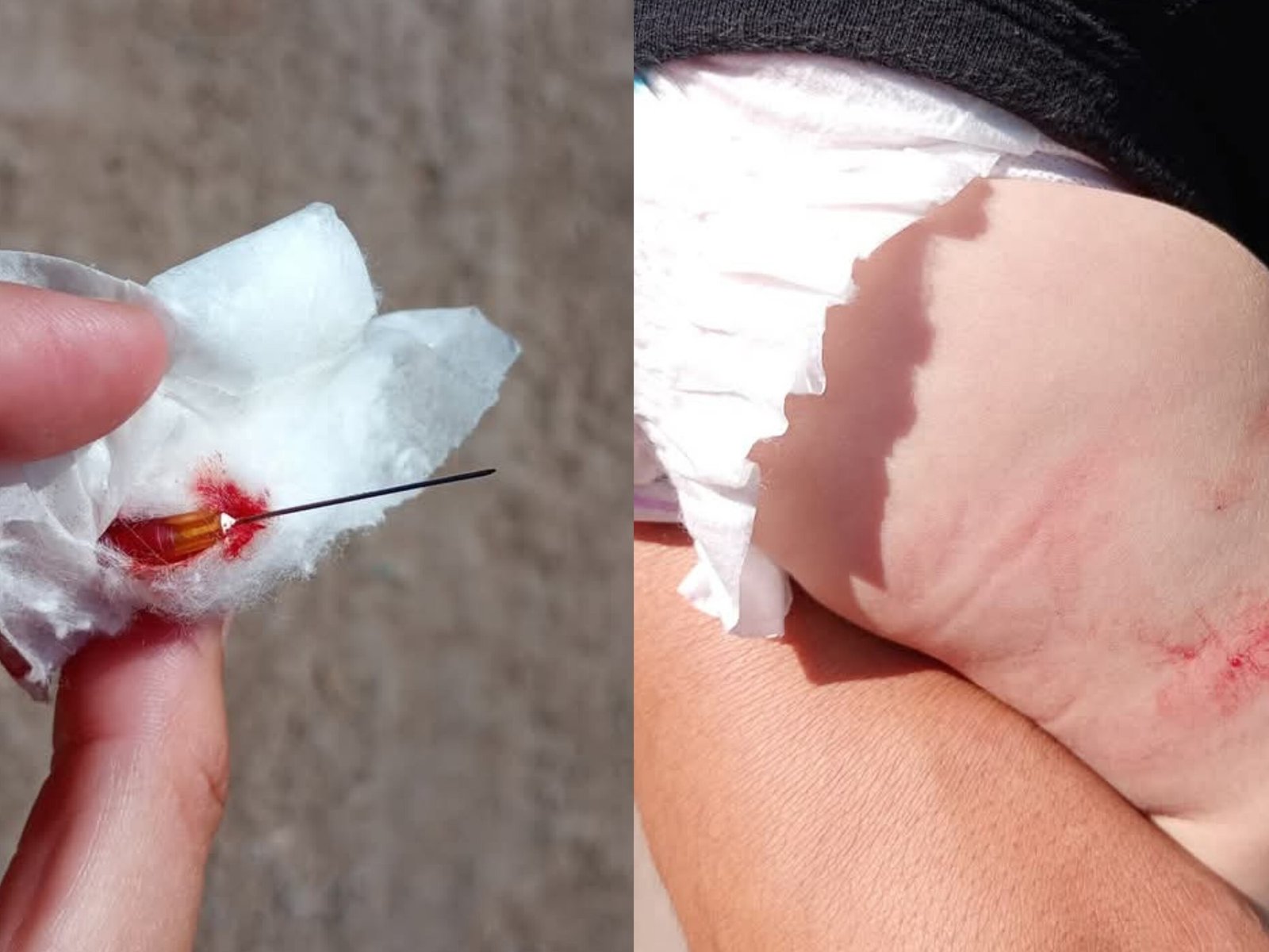 La odisea de una mujer que llevó a vacunar a su bebé de cuatro meses y descubrió que le dejaron la aguja clavada en la pierna