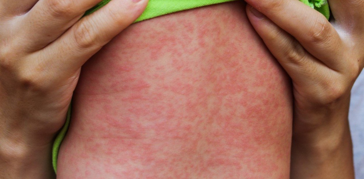 Hay alerta oficial por cuatro brotes de sarampión con 500 casos bajo la lupa y un pedido desesperado