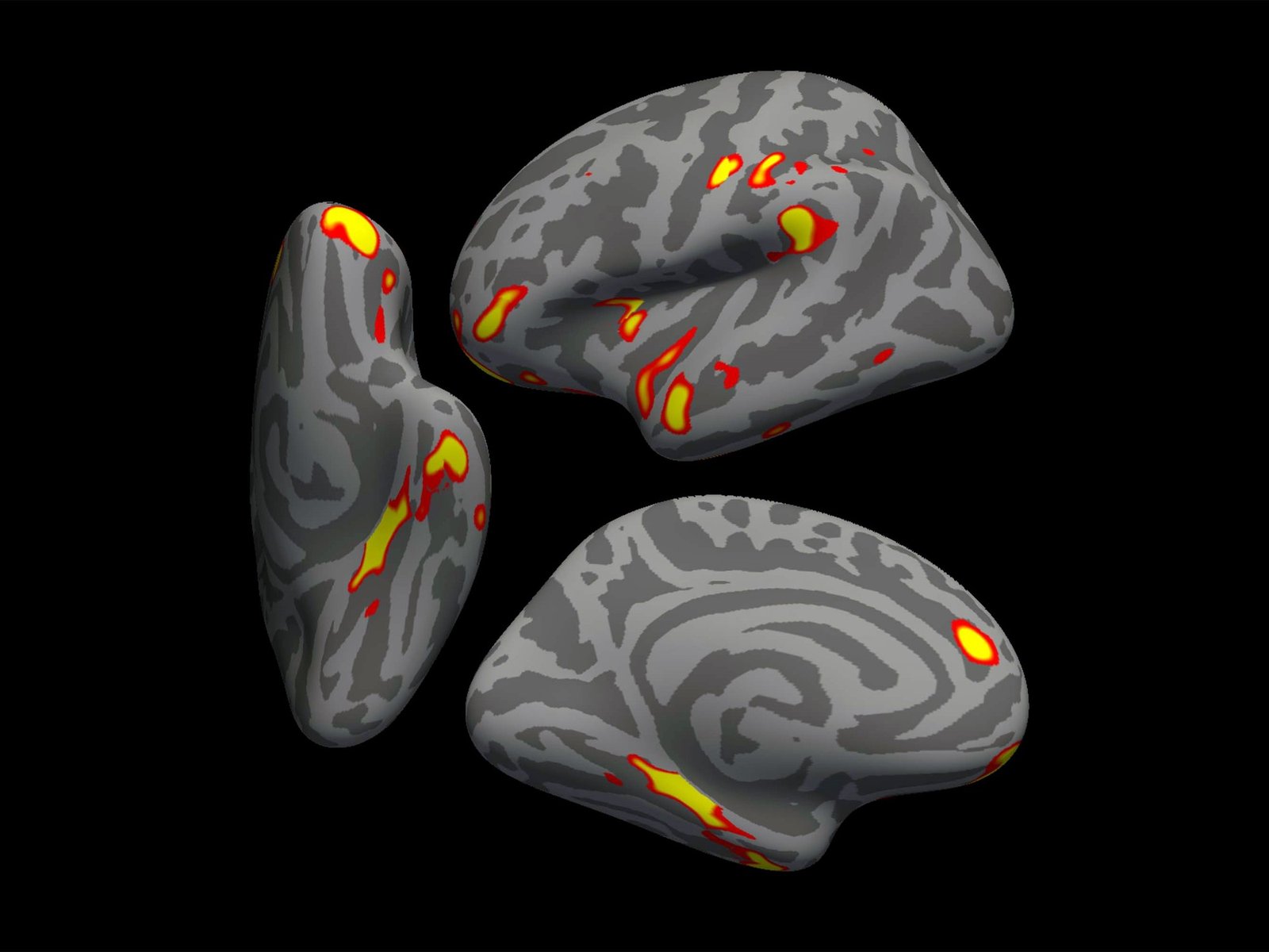 Identifican una particular atrofia del cerebro en la gente que tuvo Covid leve y no estaba vacunada