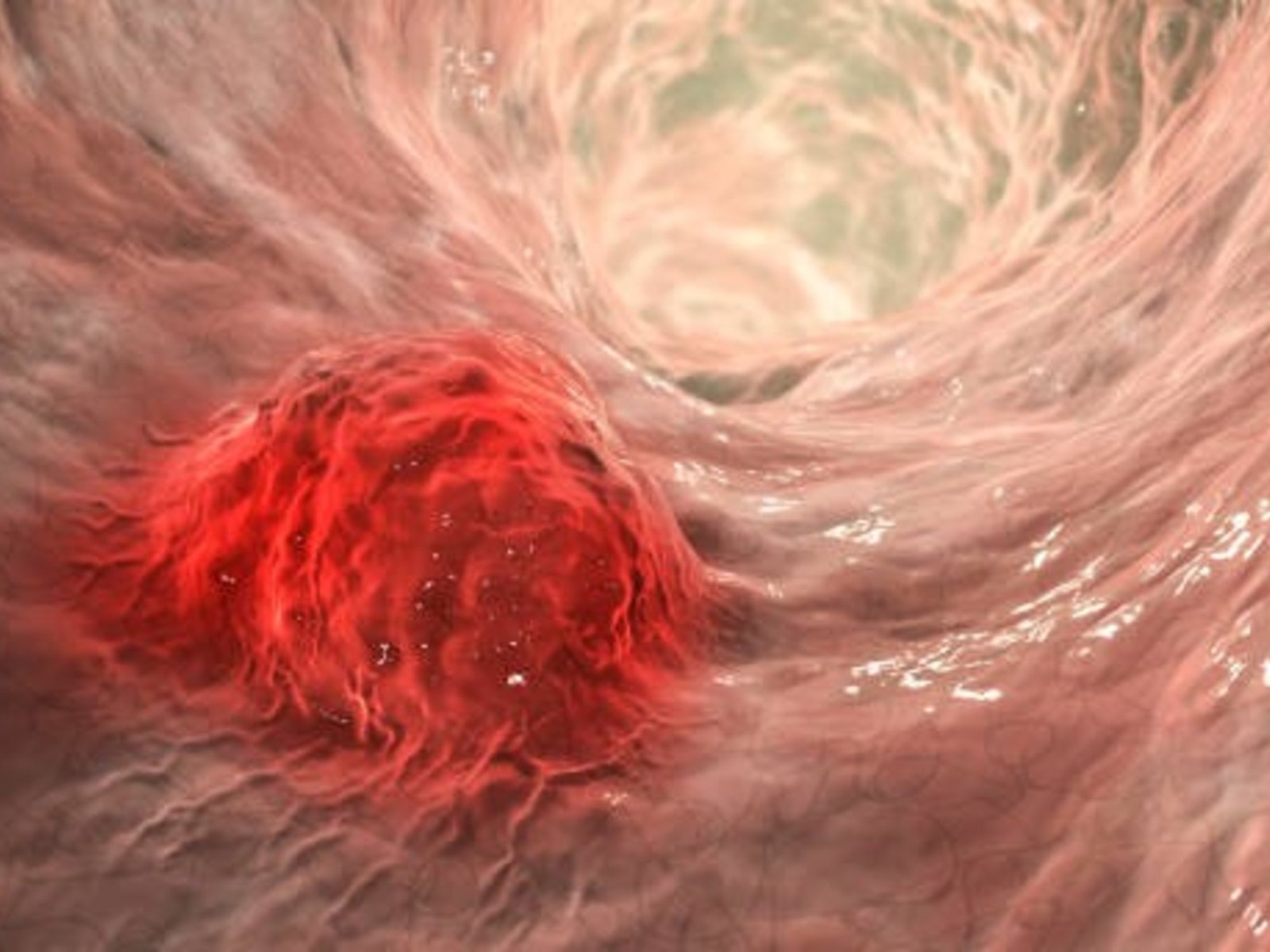 Las dos enfermedades que pueden derivar en cáncer de colon y por qué Argentina encabeza el ranking regional