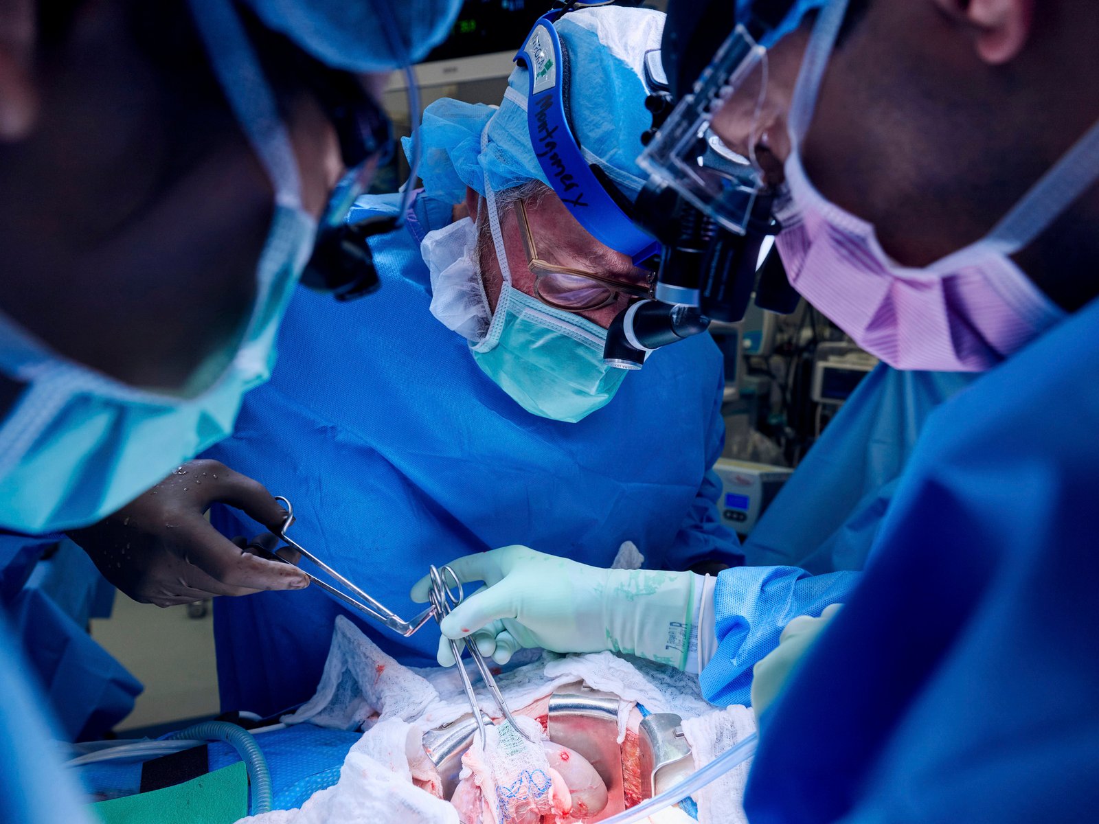 Por primera vez lograron trasplantar el pulmón de un cerdo a una persona: qué posibilidades abre