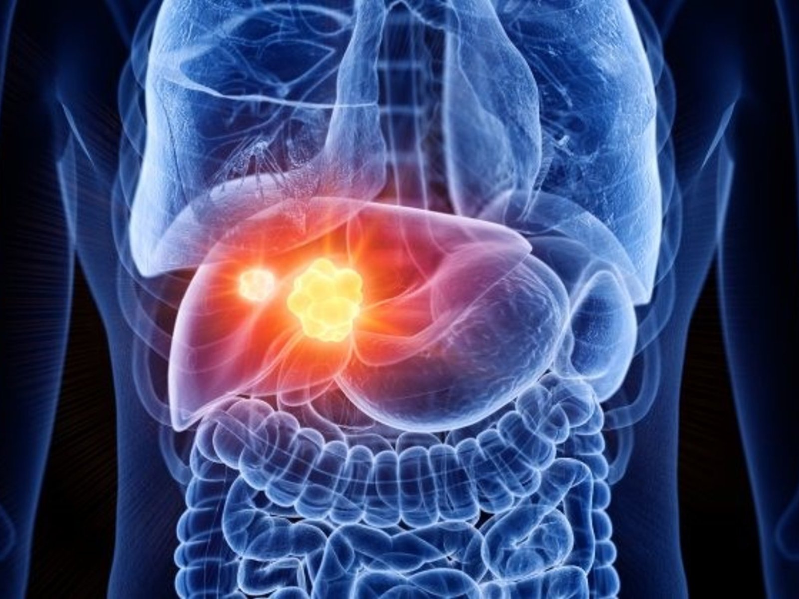 Un nuevo estudio asegura que tres de cada cinco casos de cáncer de hígado pueden prevenirse: la receta