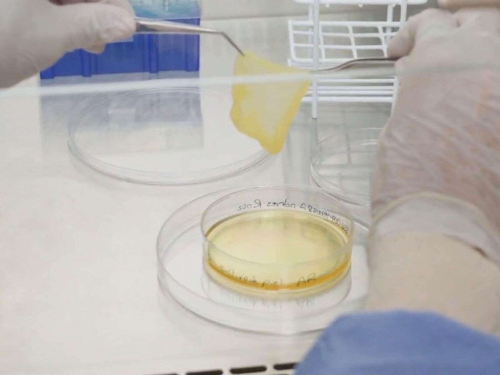 Crean en Argentina una novedosa manera de recuperar la propia piel tras sufrir una quemadura