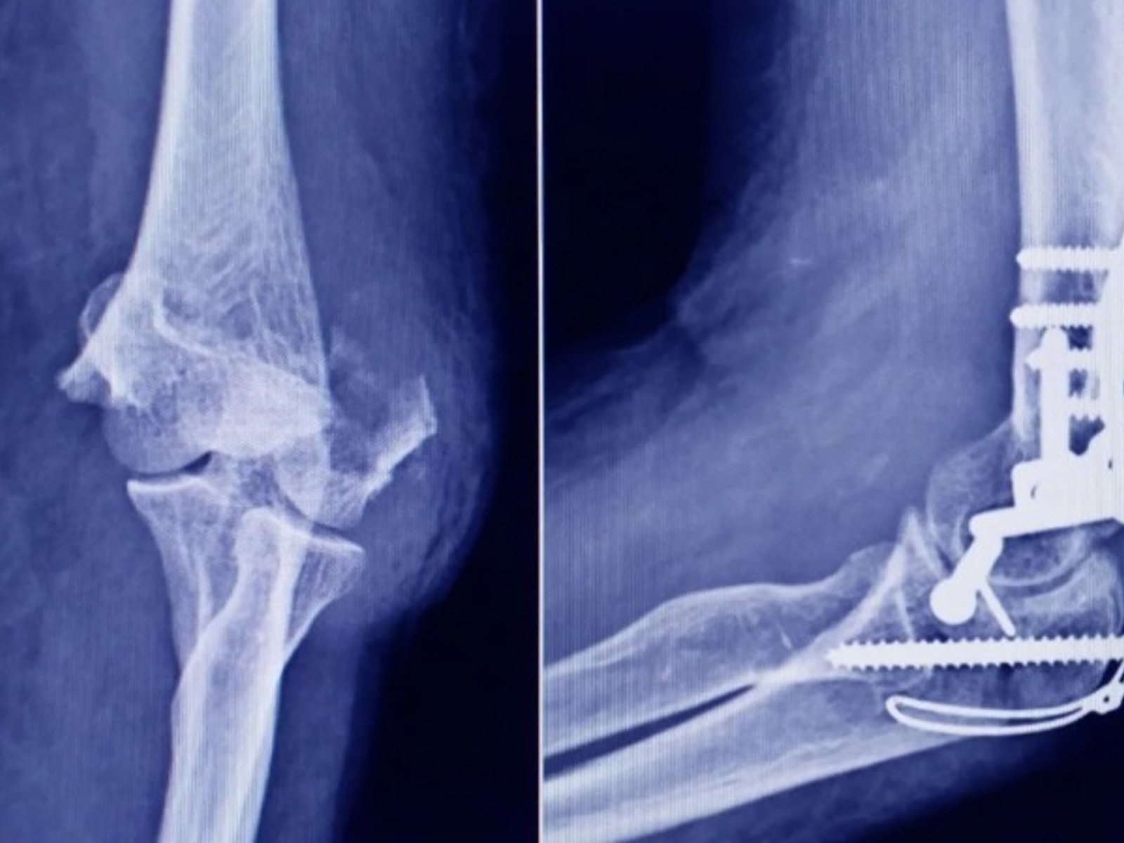 La ANMAT advierte que un tornillo utilizado en cirugías traumatológicas fue falsificado