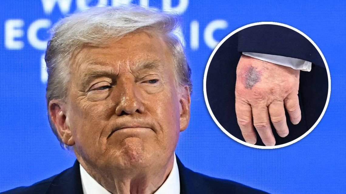 Trump habló del hematoma de su mano izquierda, que generó preocupación por su salud