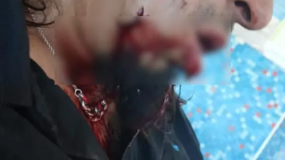 Qué se sabe del hombre baleado en el rostro en Máximo Abásolo