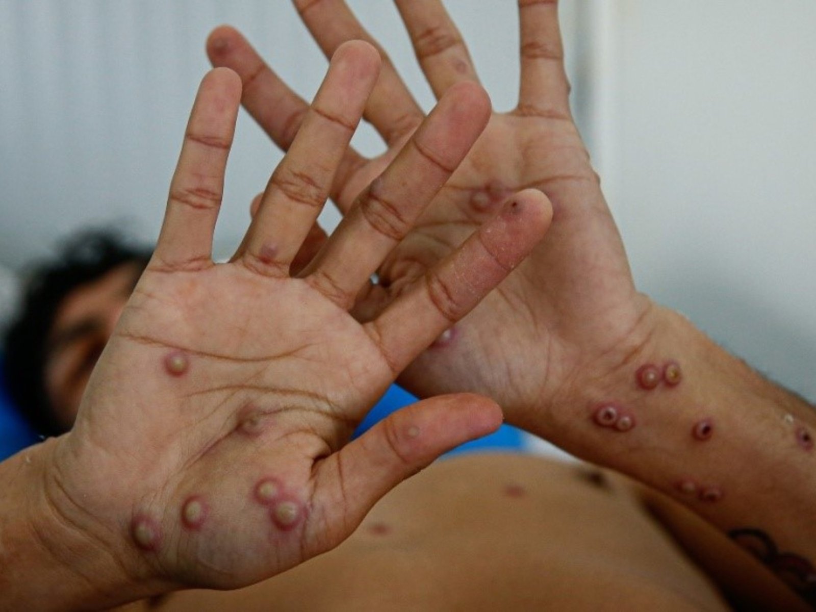 Registran en Argentina el primer caso de la cepa más agresiva y contagiosa de la "viruela del mono"