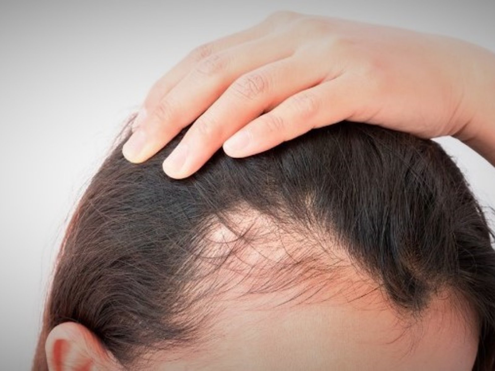 Confirman una causa poco conocida de la pérdida de cabello por un tratamiento médico cada vez más usado