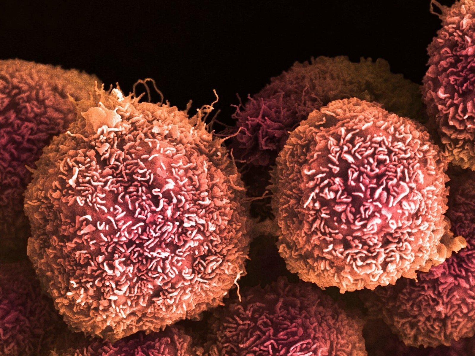 Una idea imposible derivó en un gran avance contra el cáncer de páncreas