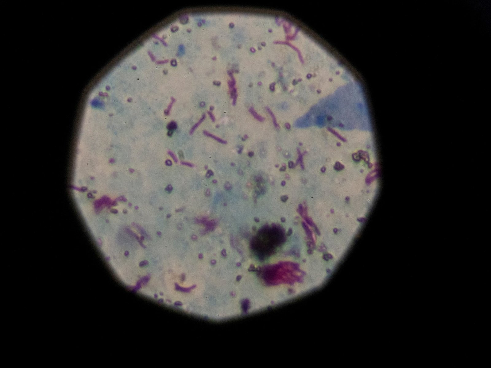 Preocupa una bacteria cuyo contagio no para de crecer y causa una muerte cada siete horas pese a tener cura