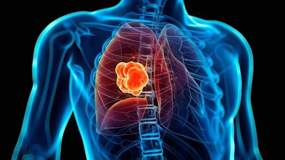 Qué son los nódulos pulmonares, la lesión por la que será operado el papa León XIV